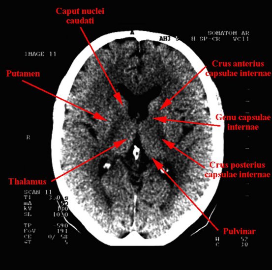 tomografia komputerowa głowy - 10c.jpg