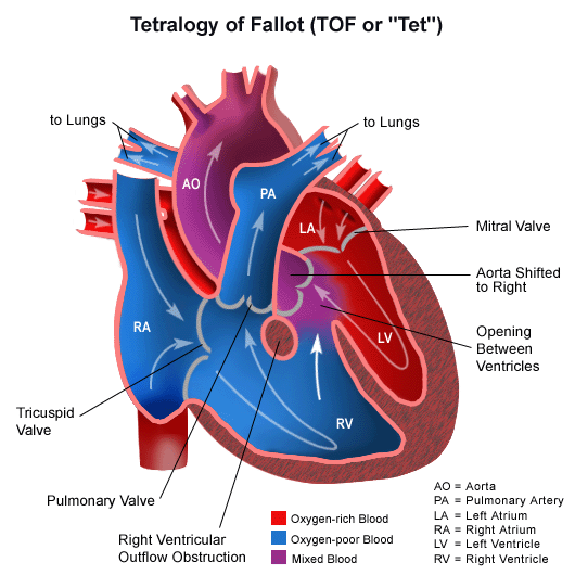 Wrodzone wady serca - tetralogia Fallota.gif